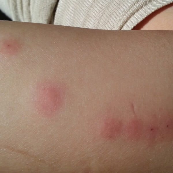 bed bugs bites