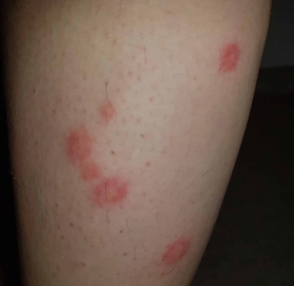 Bed Bug Bites In ZigZag Pattern