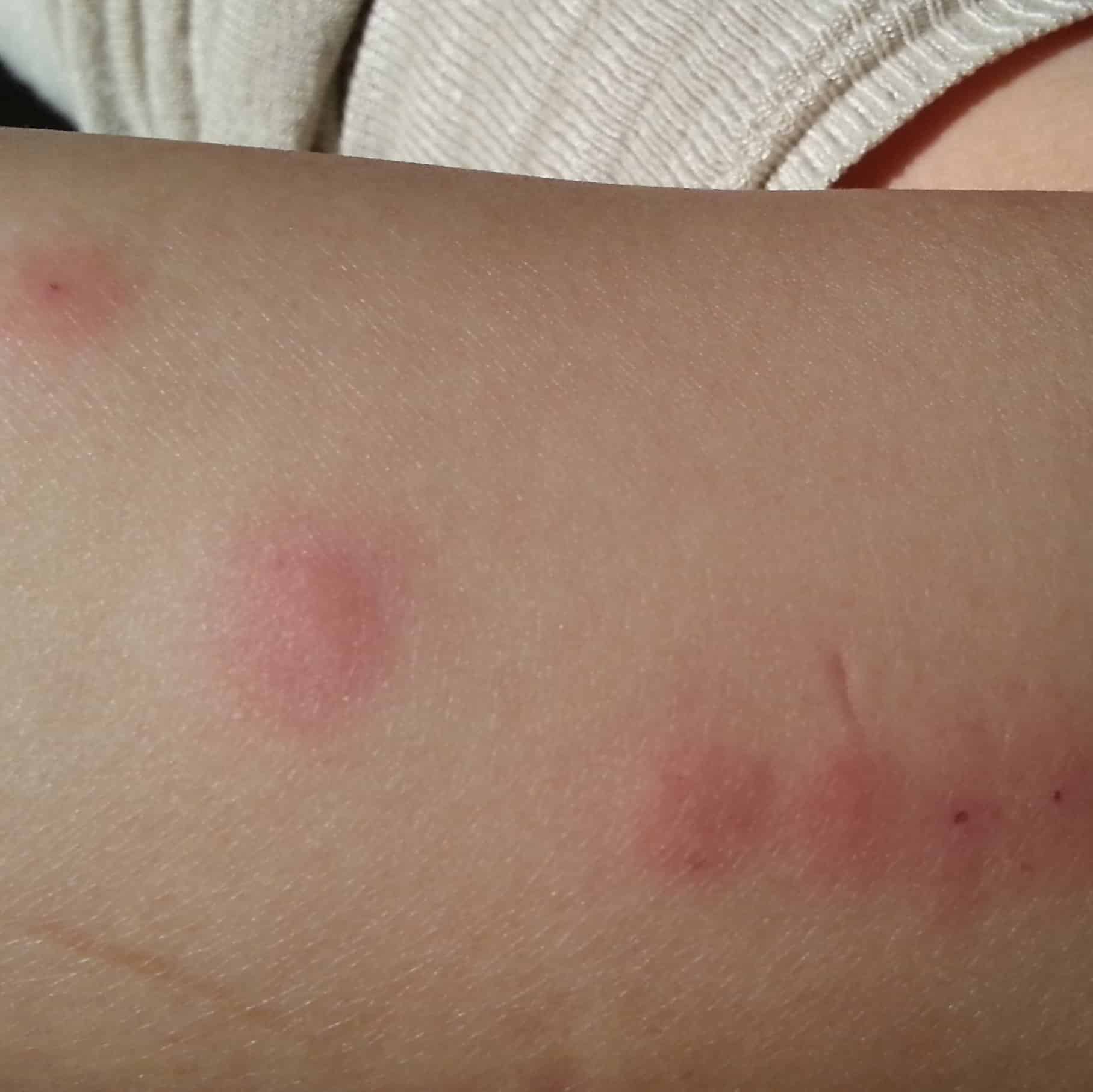 Bed Bug Bites On Arm