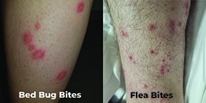 Bed Bug Bites vs Flea Bites On Legs