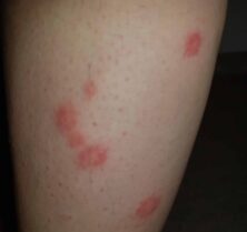 Bed Bug Symptoms