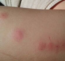 Bed Bugs Bite Photos