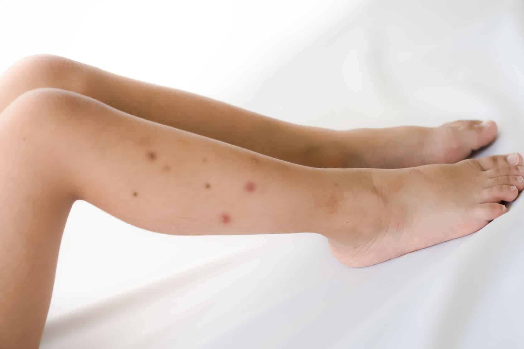 a-guide-to-bed-bug-allergies-bed-bug-treatment