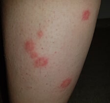 dust mites bites vs bed bugs bites