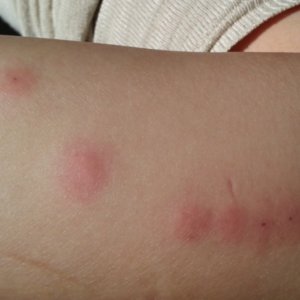 What Are Bed Bugs | Bed Bug Bites Treatment | DIY Bed Bug Solutions