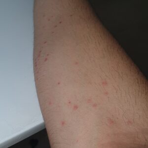 9 Images Of Bed Bug Bites: Identify, Treat & Prevent Bedbugs