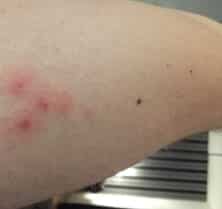 bed bug bites on leg