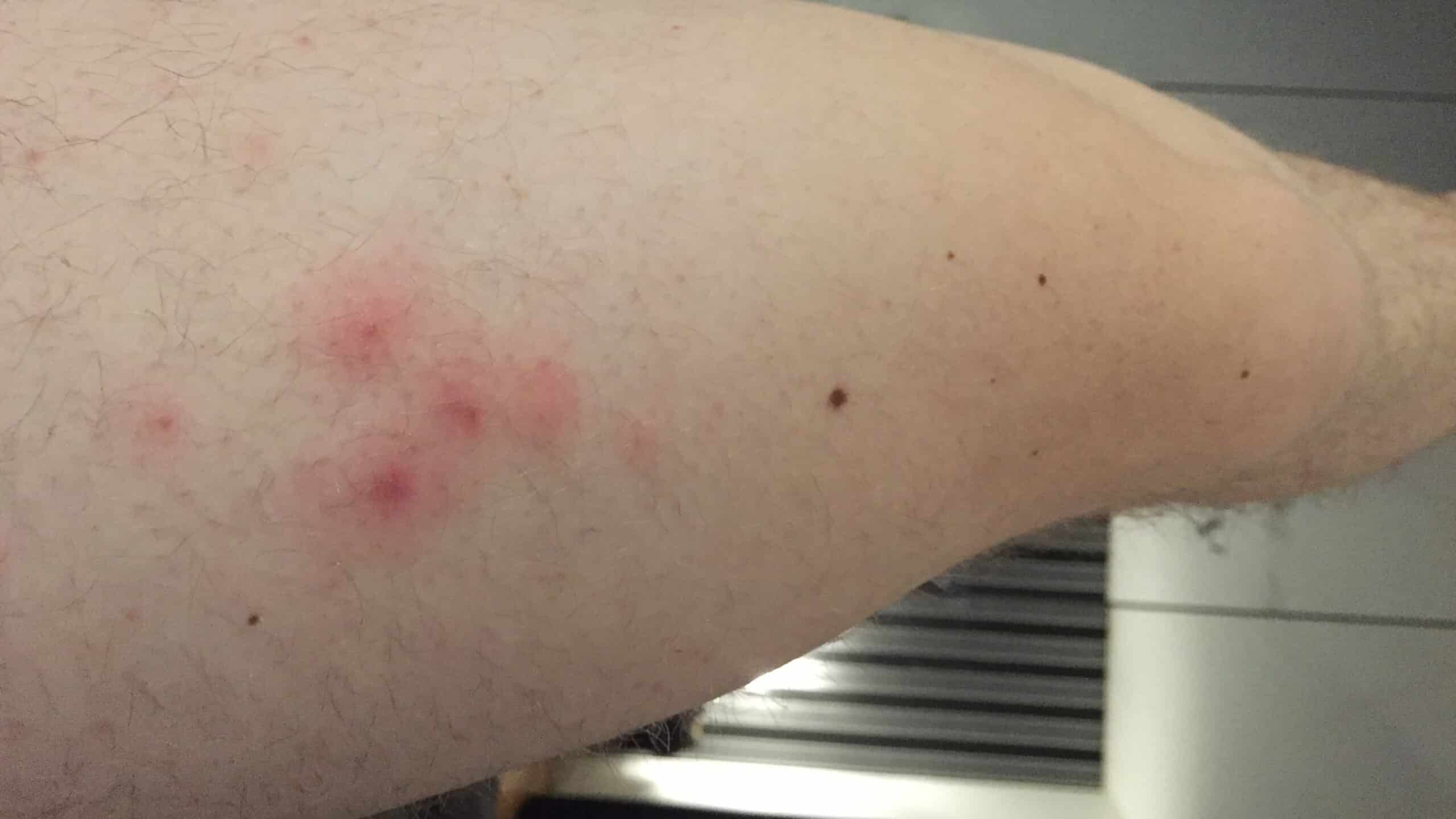 bed bug bites on leg