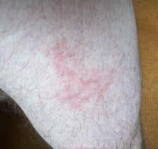 bed bug rash