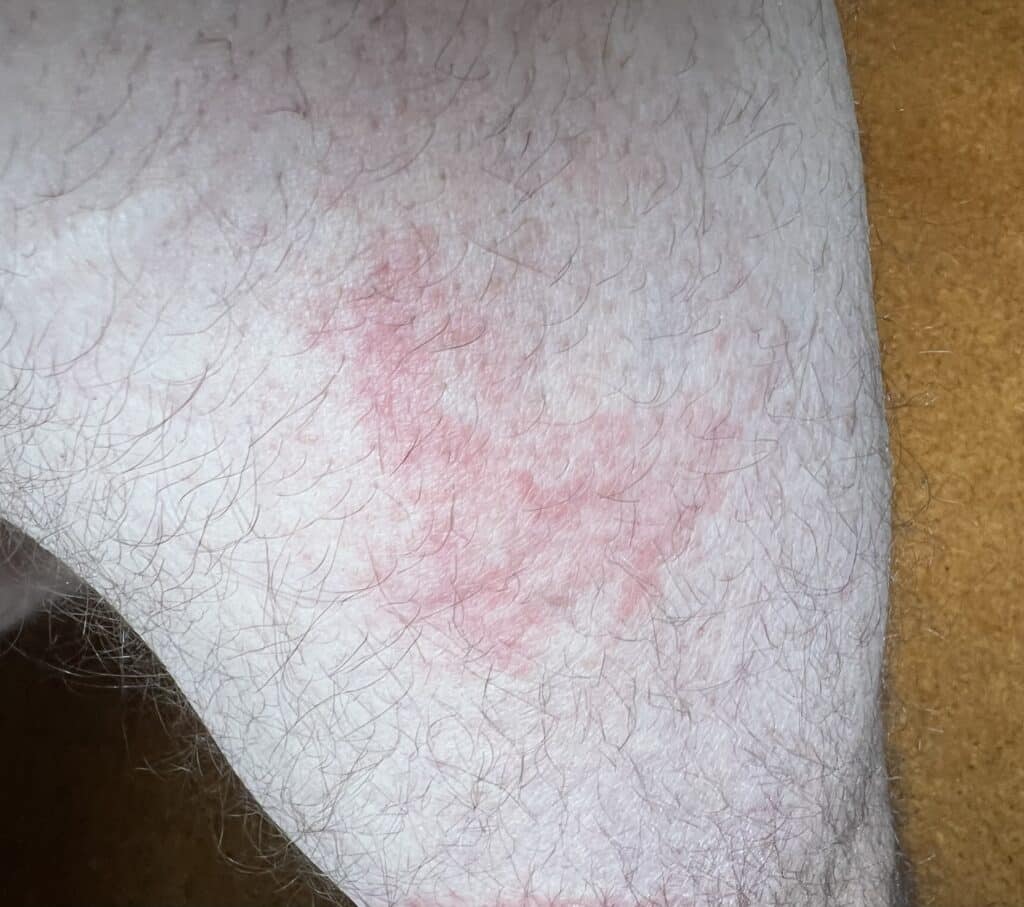 dust mite bites on legs