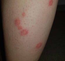 bed bug signs and symptoms