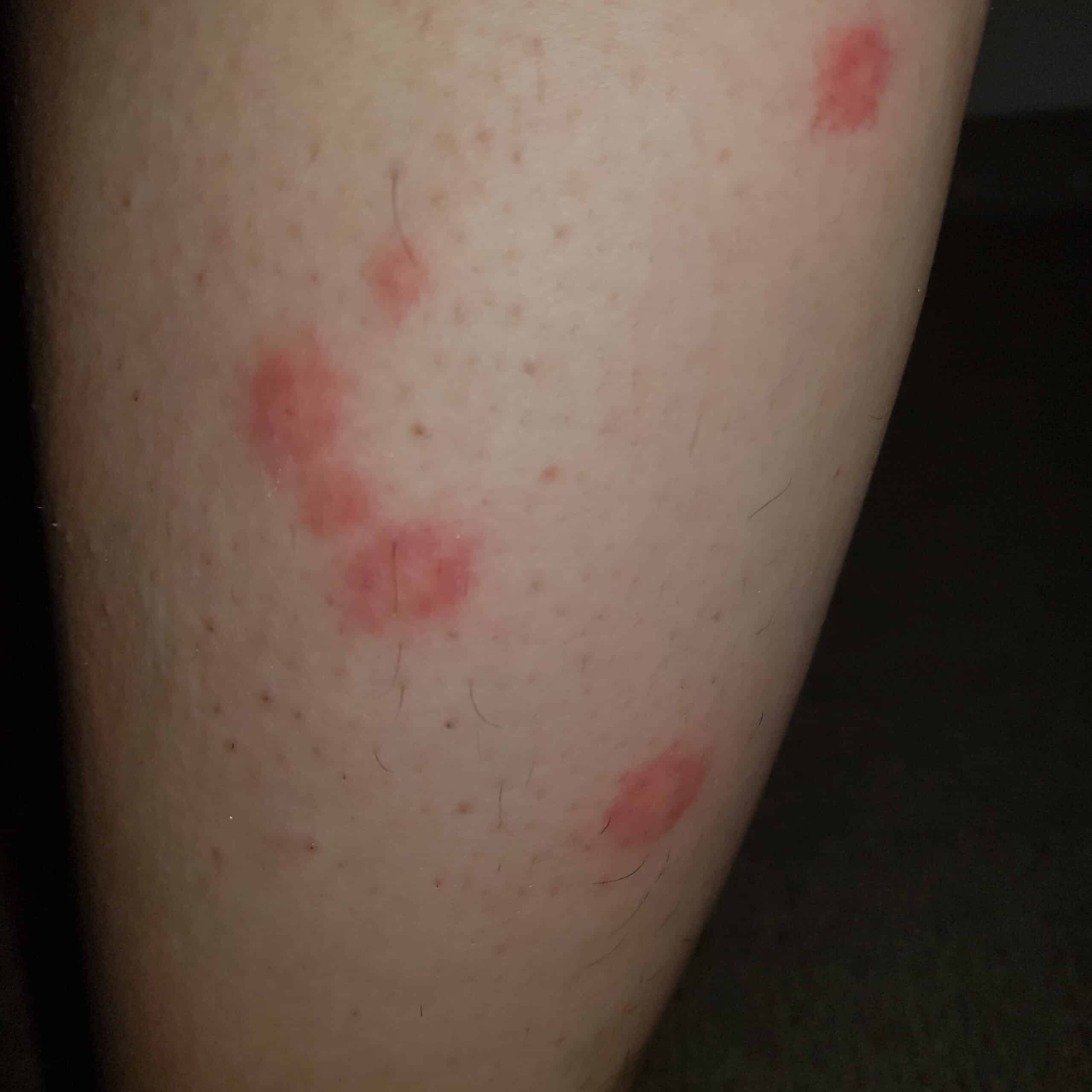 bed bug signs and symptoms