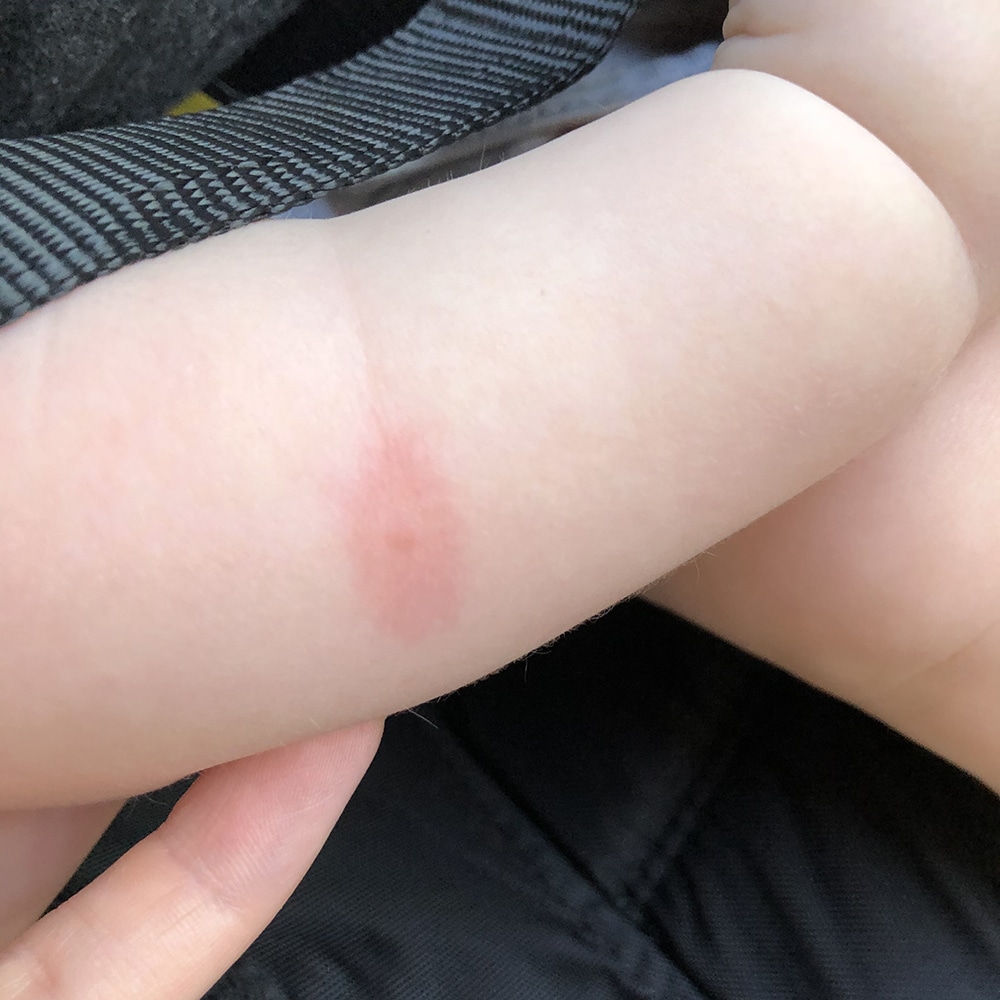 bed bug bite on baby