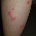 Bed Bug Bites On Leg