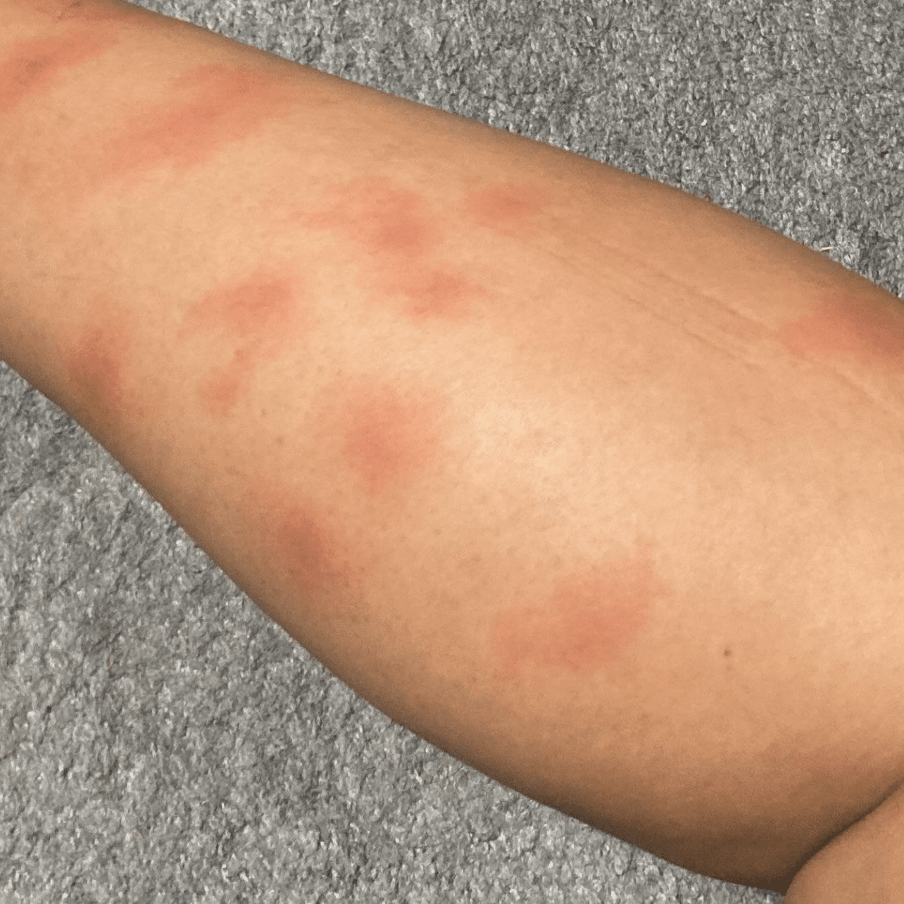 mosquito bites