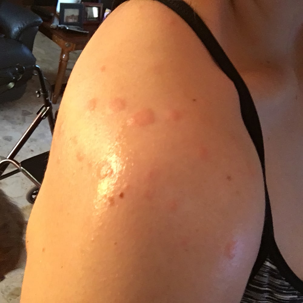 Bed Bug Bites On Shoulder